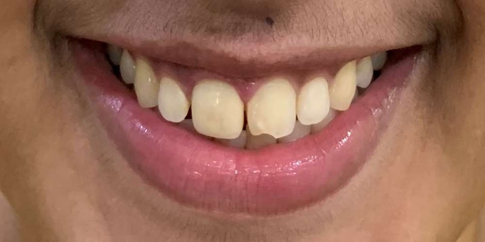 Patient 1 Before