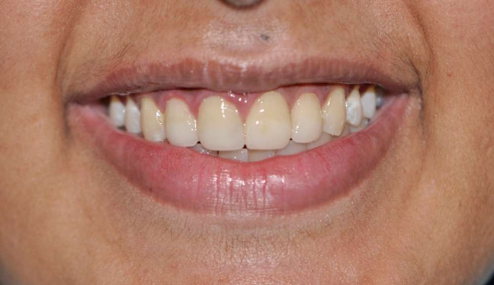 Patient 1 After