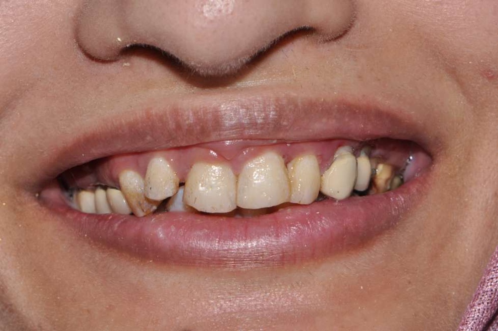 Patient 5 Before