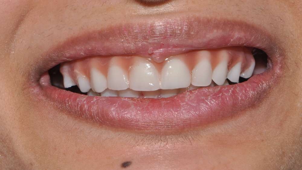 Patient 5 After