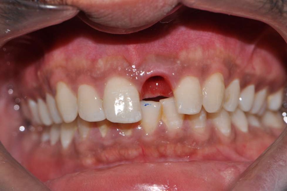 Patient 6 Before