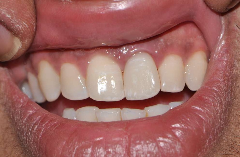 Patient 6 After