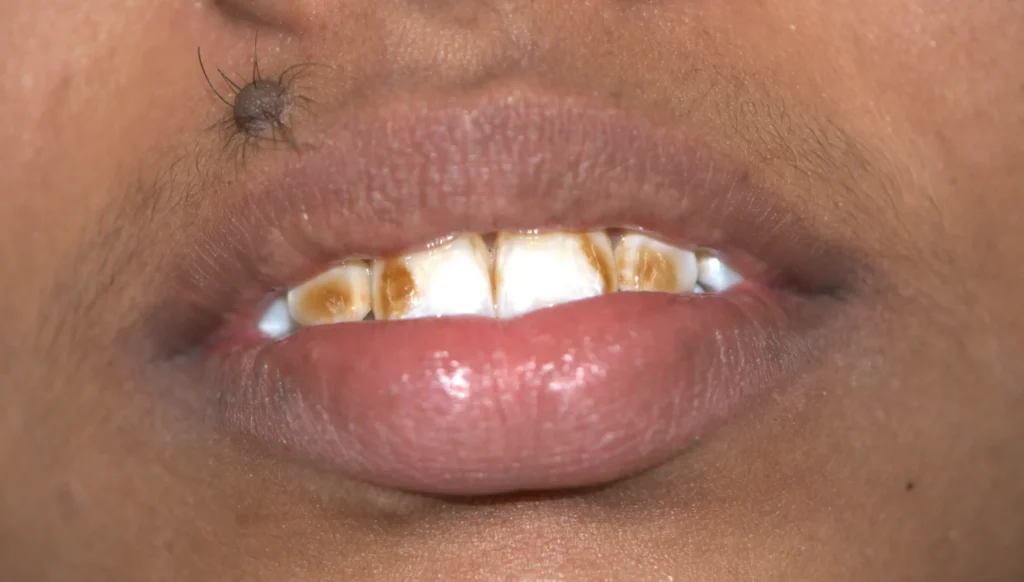 Patient 8 Before