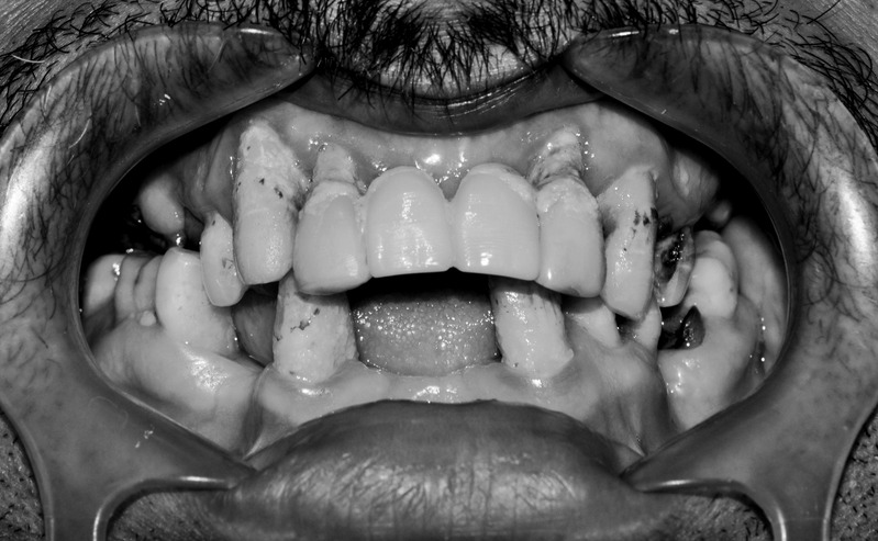 Before dental implants treatment