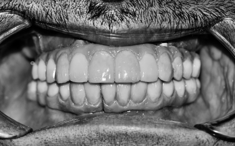 After dental implants treatment