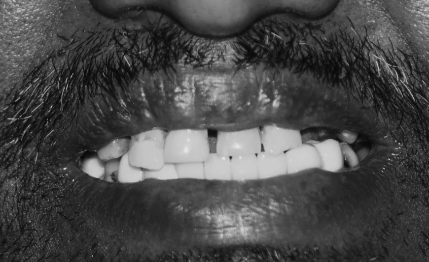 Before dental treatment case 2