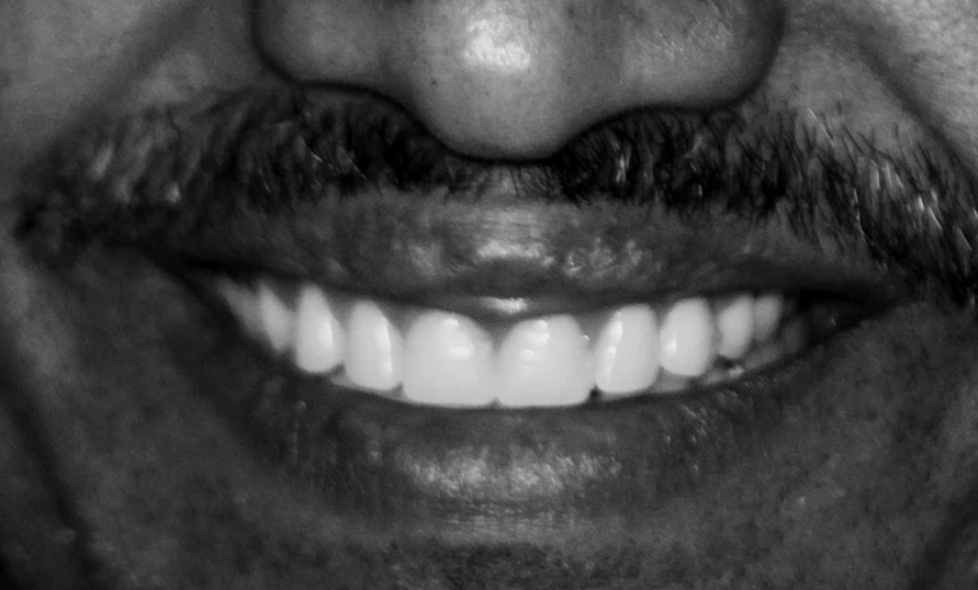 After dental treatment case 2