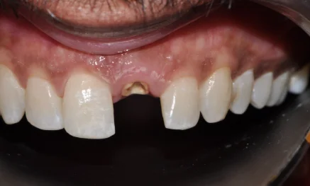 Before Dental Treatment