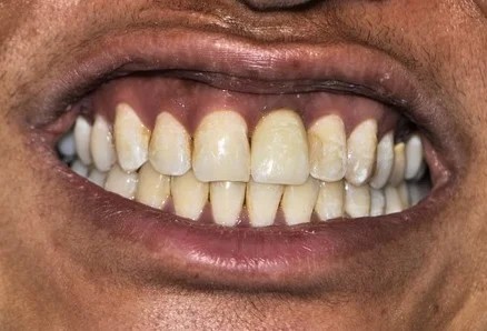 After Dental Treatment