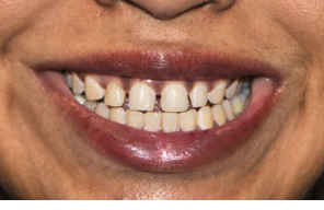 Before treatment