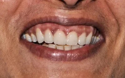 After treatment