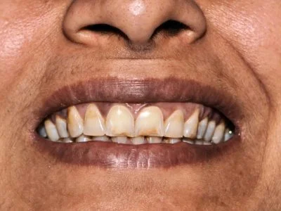 Before treatment
