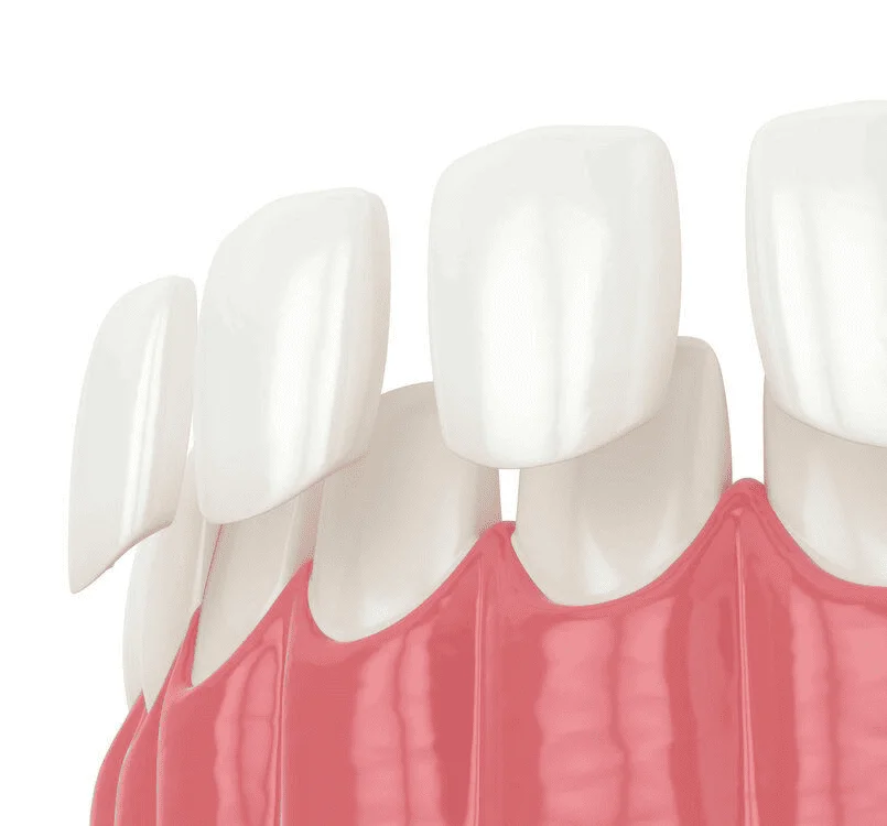 Ceramic Veneers Diagram
