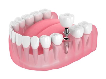 Single Tooth Implant