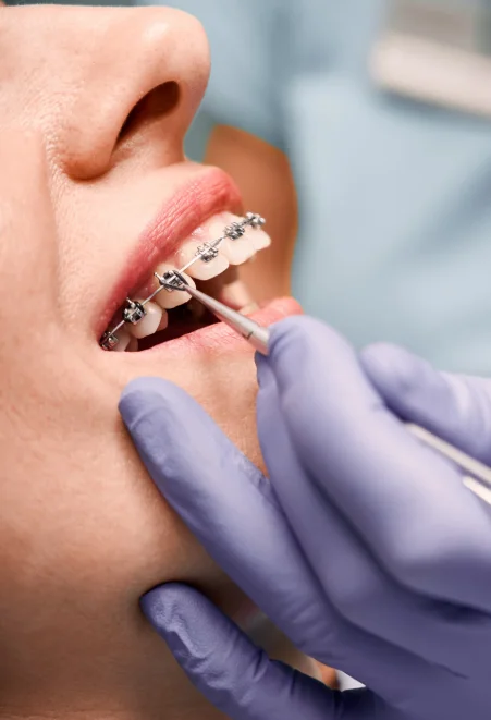 Orthodontic Treatment in Progress